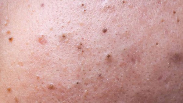 Know the 6 Types Of Pimples and Their Treatments | Seed in the Pimple ...